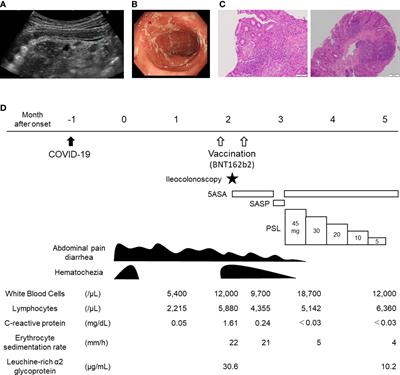 Case report: Immunological characteristics of de novo ulcerative colitis in a child post COVID-19